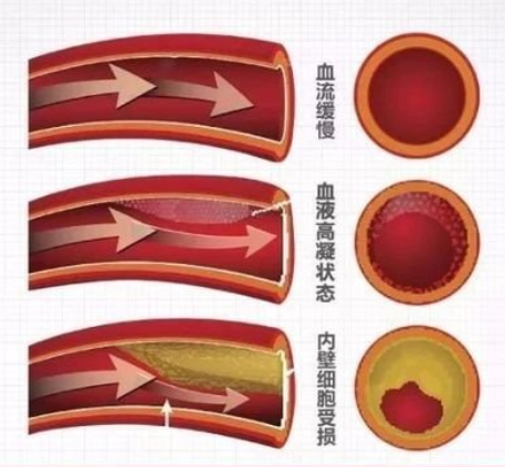 血流缓慢、血管壁损伤、血液高凝.png